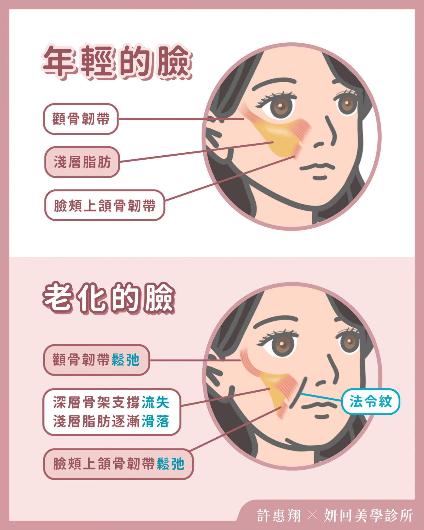 法令紋好發年齡示意圖-膠原蛋白流失