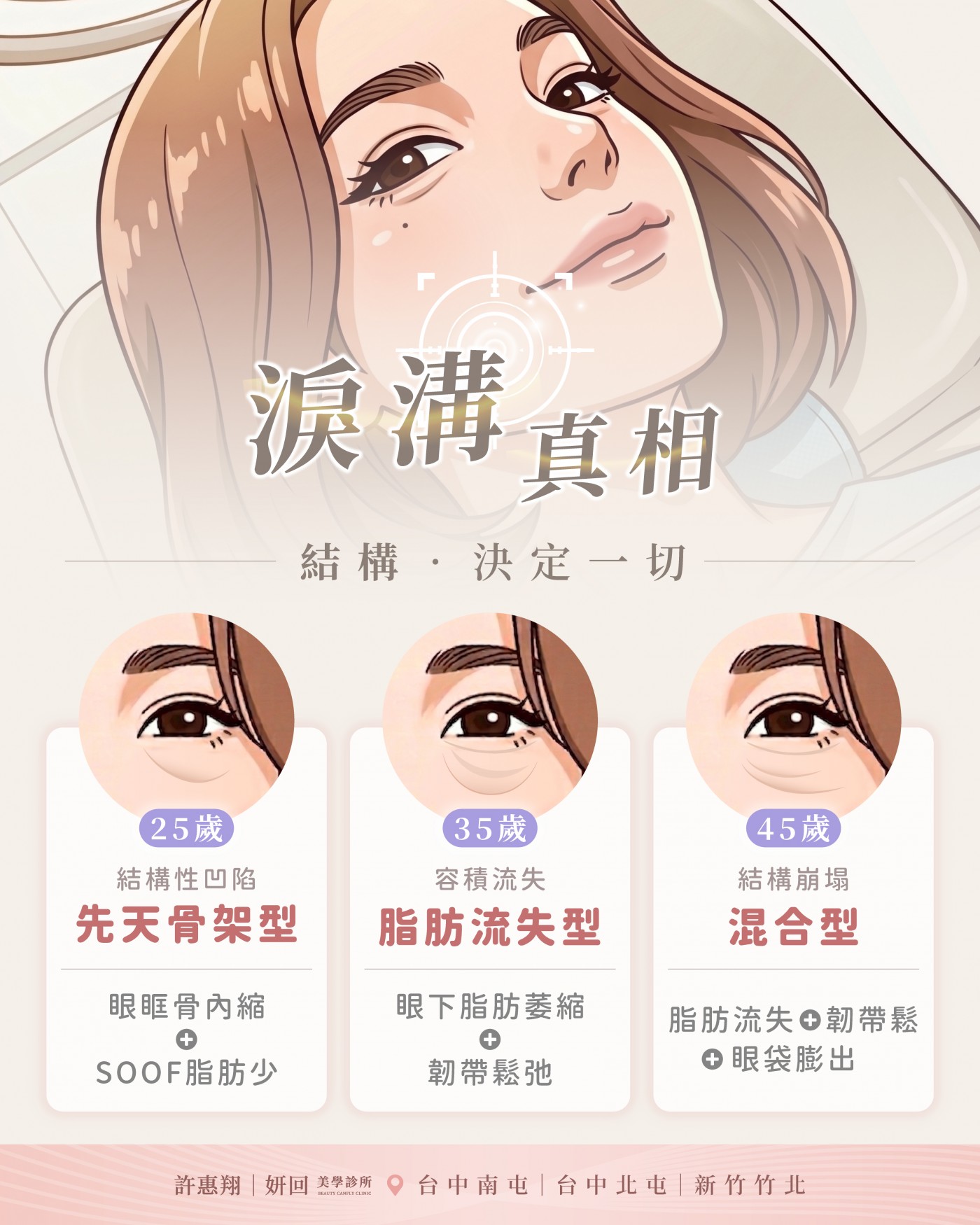年齡分型與淚溝結構示意圖