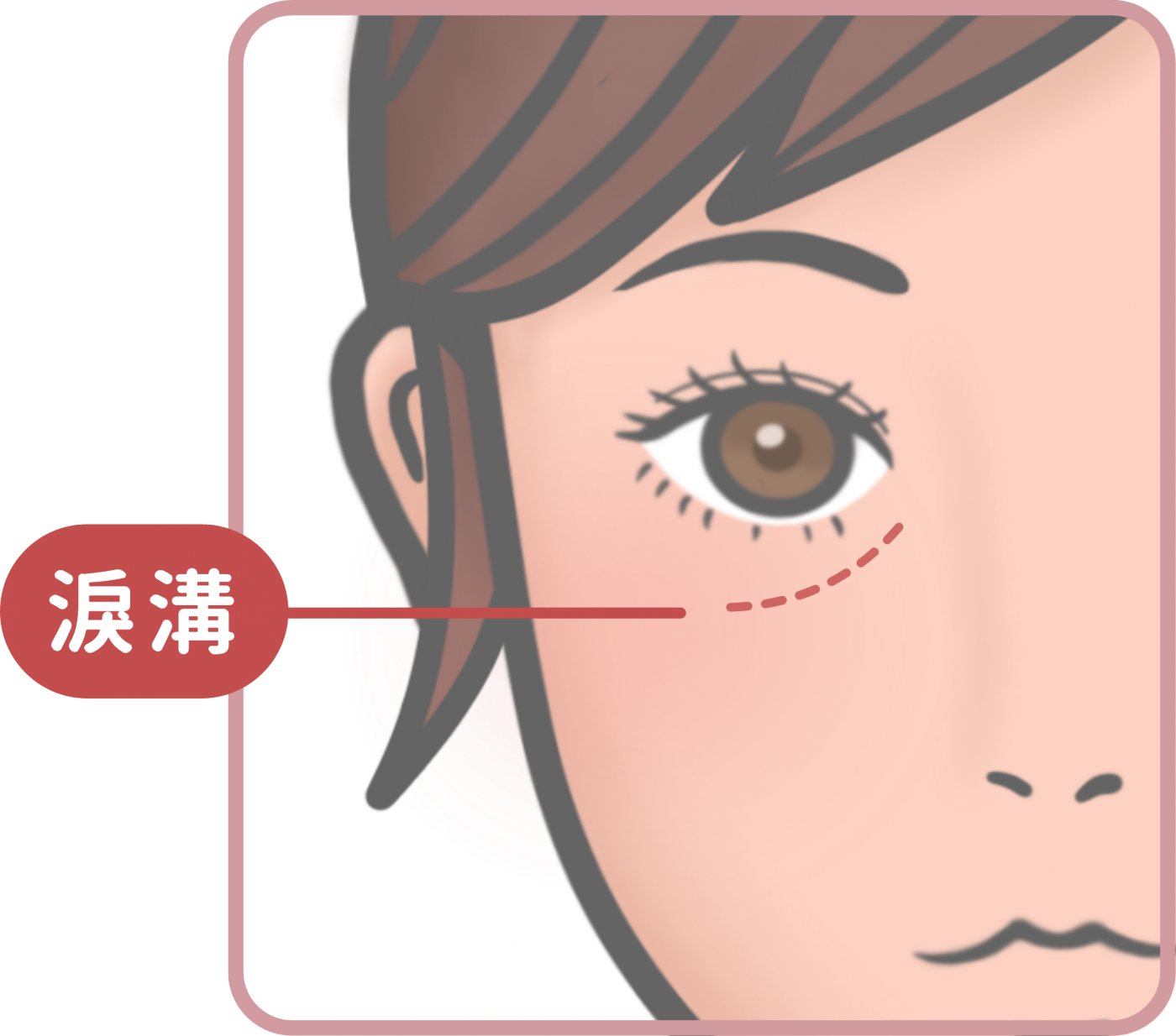 淚溝形成原因圖解-韌帶鬆弛與骨架內縮