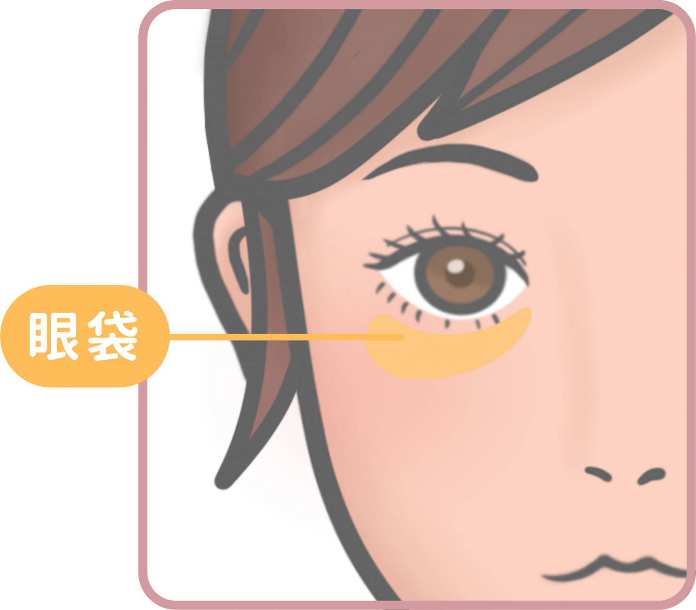 眼袋形成原因圖解-脂肪膨出與隔膜鬆弛
