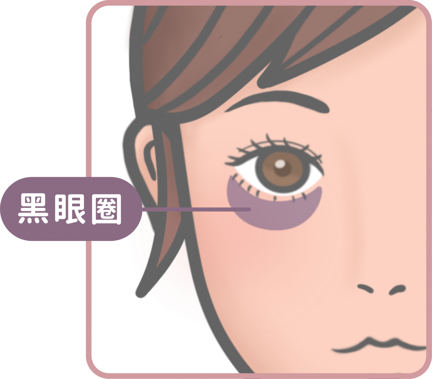 黑眼圈形成原因圖解-血管型色素型陰影型