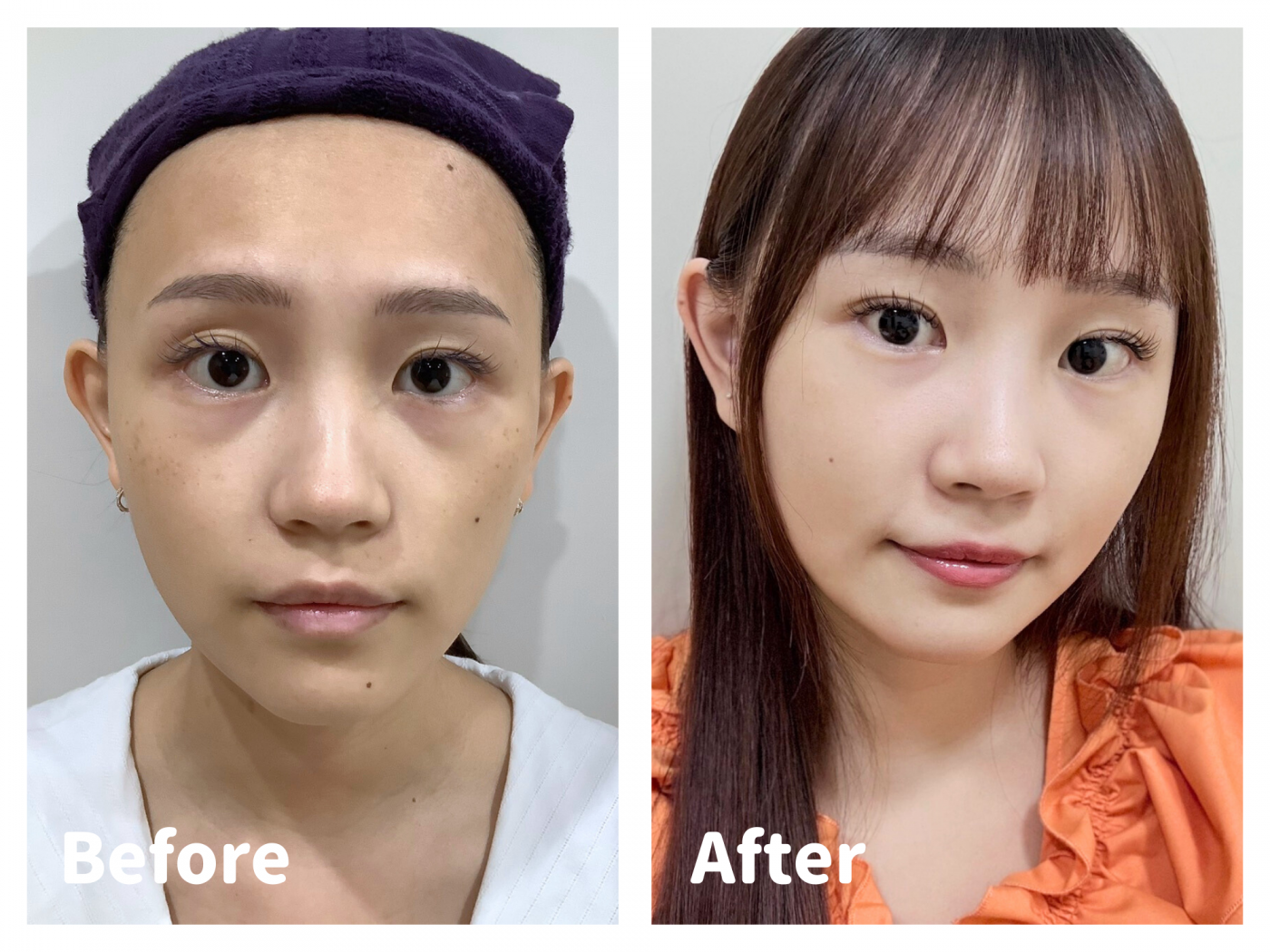 黑眼圈治療示意圖-熊貓針填補與雷射淡化