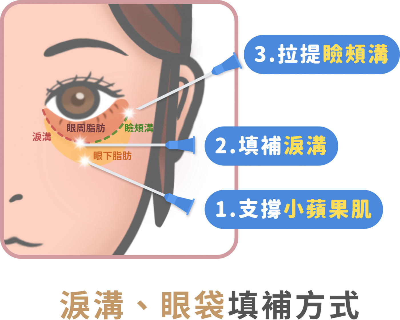 淚溝治療前後對比-許惠翔醫師