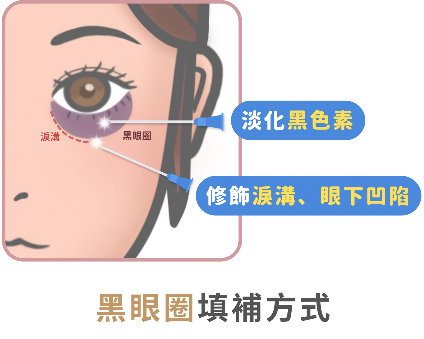 黑眼圈消除前後對比-熊貓針實例